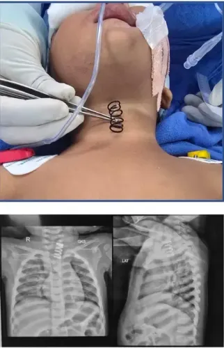 How Did AIIMS Doctors Successfully Extract a 2-Inch Metal Spring from a 14-Month-Old's Food Pipe?