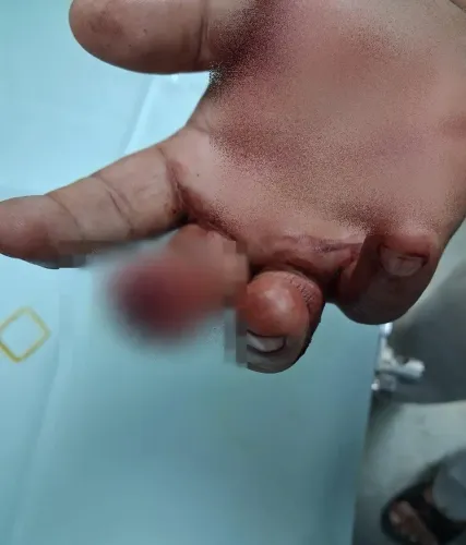 Customer Arrested After Biting Shopkeeper's Finger in Mumbai Samosa Dispute