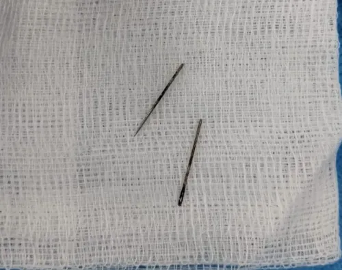 AIIMS Rajkot doctors remove metal pin from girl's intestine via endoscopy