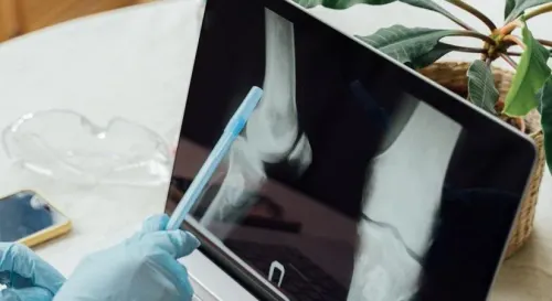 Can Indian Researchers Revolutionize Early Detection of Bone Cancer?