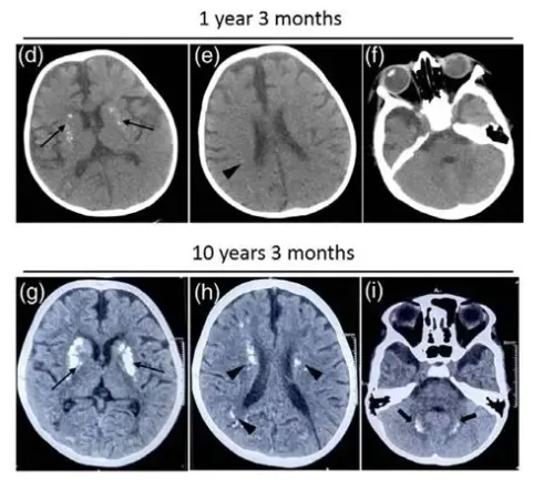 Could a Rare Gene Mutation Be Behind Recurrent Neurological Decline in Children?