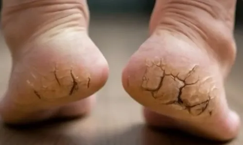 क्या इस आयुर्वेदिक उपाय से फटी एड़ियों से छुटकारा पाया जा सकता है?