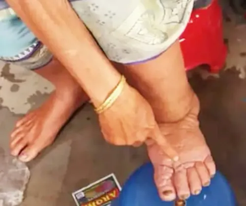 Will the Mass Drug Programme Against Filariasis in Gujarat Begin on February 10?