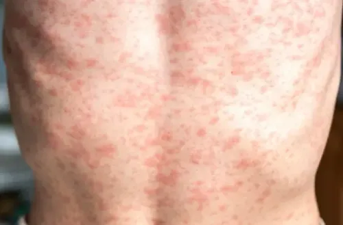 Confirmed Measles Cases in Mongolia Surpass 500