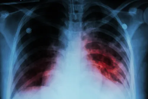 Singapore Sees 1,156 New Tuberculosis Cases in 2024, Down from 2023
