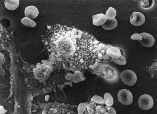 Research Reveals Link Between Malaria and Childhood Cancer