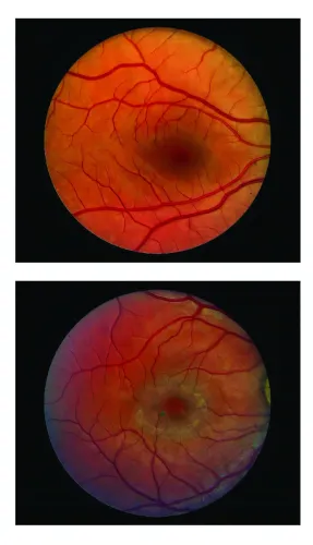 Can a Surgical Implant Help Slow Vision Loss from Blinding Eye Disease?