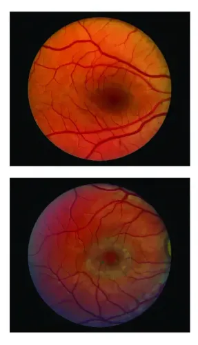 Surgical implant can slow down vision loss caused by blinding eye disease: Study