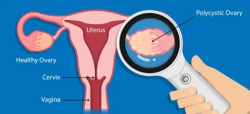 How Does PCOS Affect Attention and Cognitive Functions?