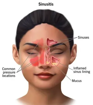 Surgery more effective in treating chronic sinus than antibiotics: Study