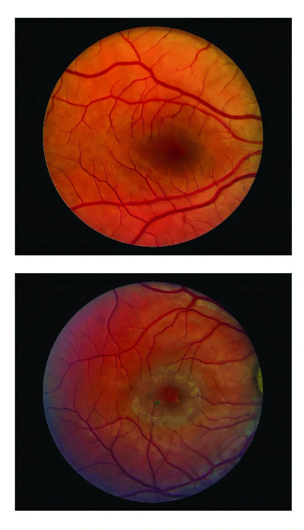 Can a Surgical Implant Help Slow Vision Loss from Blinding Eye Disease?