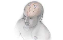 Is AIIMS Leading the Way with India’s First Deep Brain Stimulation Workshop for Parkinson’s and Movement Disorders?