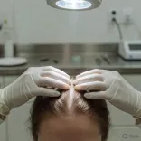 Arthritis drug upadacitinib restores full hair in alopecia trial