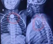 क्या गांधीनगर के सिविल अस्पताल में बच्चों के गले से सिक्का निकाला गया?