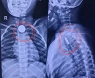 गांधीनगर: सिविल अस्पताल में दो बच्चों के गले से सिक्का निकाला, डॉक्टरों ने अभिभावकों से की ये अपील