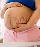 गर्भावस्था के दौरान स्ट्रेच मार्क्स? जानें आयुर्वेद से बचाव के उपाय