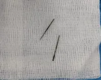AIIMS Rajkot doctors remove metal pin from girl's intestine via endoscopy