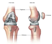Do Experts Believe India Requires More Skilled Surgeons for Revision Knee and Hip Replacement Surgeries?