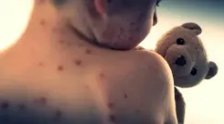 What’s Causing the Surge in Measles Cases in Israel?