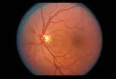 क्या है डायबिटिक रेटिनोपैथी, जिससे जा सकती है आंखों की रोशनी?