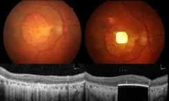 Can a New Retinal Implant Restore Vision in Patients with Irreversible Blindness?