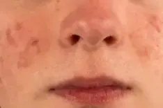 ऑयली या ड्राई स्किन, नीम से बनाएं ये तीन फेस पैक और पाएं मुंहासों से छुटकारा