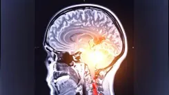 Oral, gut bacteria worsening Parkinson's disease: Study