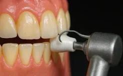 पीले दांतों से हैं परेशान? इन तरीकों से लौटाएं मोती जैसी चमक 