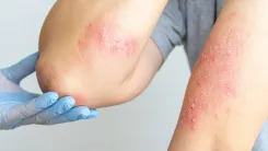 क्या सोरायसिस एक एलर्जी है या इम्यून सिस्टम की गड़बड़ी?