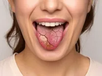 क्या मुंह का सूखना साधारण है? ये हैं कई बीमारियों के संकेत