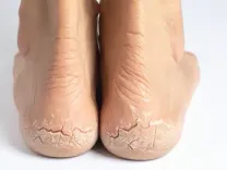 सर्दियों में एड़ी फटने से हैं परेशान, आयुर्वेद से जानें कारण और राहत के उपाय