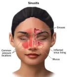 Surgery more effective in treating chronic sinus than antibiotics: Study