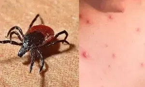 Tamil Nadu Health Authorities on Alert as Scrub Typhus Cases Surge