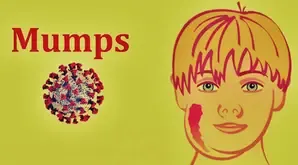 Tamil Nadu Raises Alarm as Mumps Cases Surge Among Schoolchildren in Coimbatore