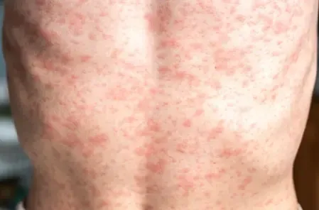 Measles Cases on the Rise in the US as Vaccination Rates Dwindle: Research