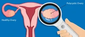 US Scientists Unravel Ovarian Cancer Origins