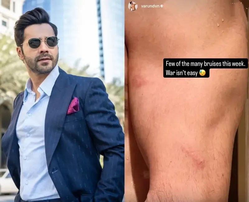 Varun Dhawan Reveals His Battle Scars from Filming