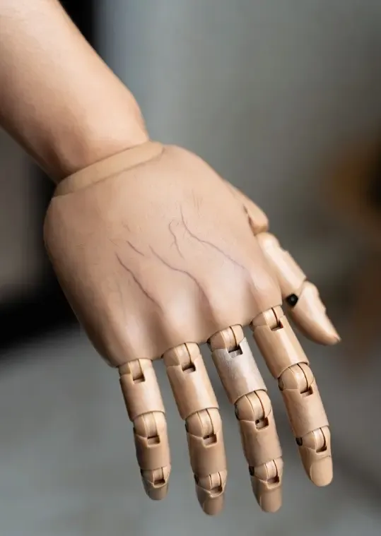 Is 9-Year-Old Vinodini from Kerala Still Waiting for a New Arm?